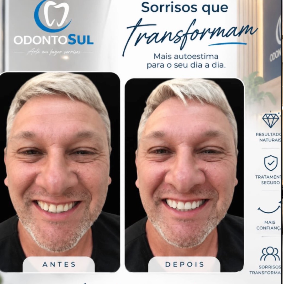 Antes e depois de clareamento e harmonização do sorriso