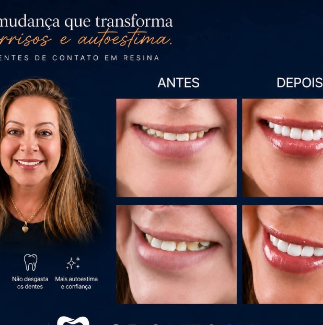 Antes e depois de facetas de contato em resina em paciente da OdontoSul